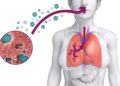 Brote de Legionella en NYC: declaran emergencia y llaman a consultar médico