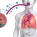 Brote de Legionella en NYC: declaran emergencia y llaman a consultar médico