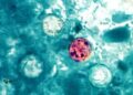 Parásito Ciclosporiasis: Aumentan casos de diarrea grave en NYC y otros estados; dominicanos en alerta