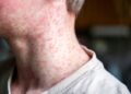 SOLN y PreCoHis alertan dominicanos en EUA sobre resurgimiento enfermedad sarampión